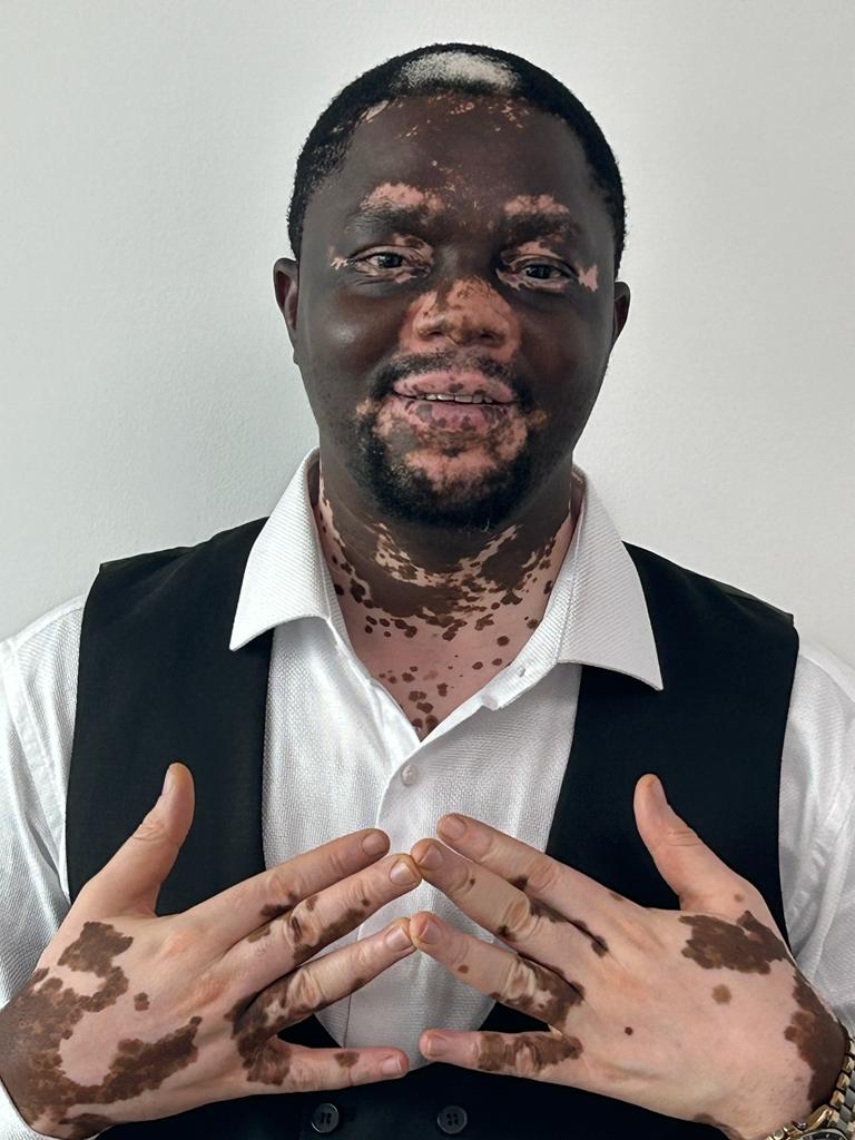 Santé : l&rsquo;OMS félicite les efforts du médecin congolais Freddy Banza dans la lutte contre le Vitiligo