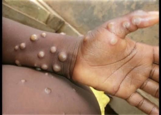 Lomami : triple alerte épidémique au Mpox, choléra et rougeole