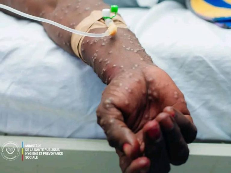 Maniema : dix cas suspects de Mpox signalés dans une église à Lubutu