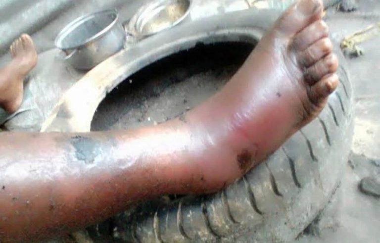 Du mystique au médical : comprendre le «Mbasu» (ulcère vasculaire chronique) à Kinshasa